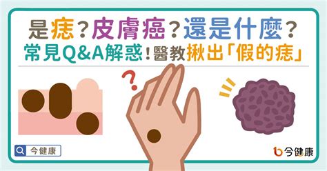 身體多痣|是痣？皮膚癌？還是什麼？常見Q&A解惑！醫教揪出「。